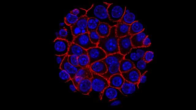 Blue and red fluorescence microscopy of pancreatic cancer cells. 