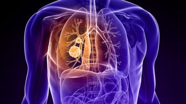 Two Drug Targets Discovered for Deadly Lung Cancer content piece image 